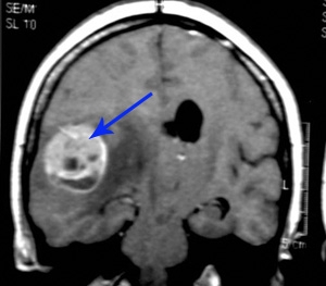 poza despre tumori cerebrale